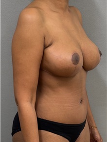 Mommy Makeover After Photo by Keshav Magge, MD; ,  - Case 50551