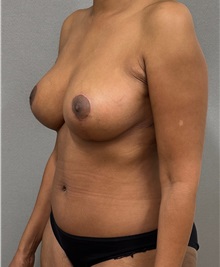 Mommy Makeover After Photo by Keshav Magge, MD; ,  - Case 50551