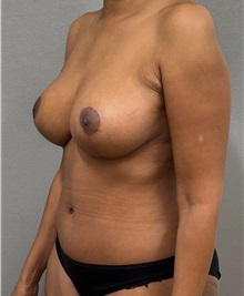 Tummy Tuck After Photo by Keshav Magge, MD; ,  - Case 50550