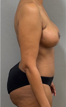 Tummy Tuck After Photo by Keshav Magge, MD; ,  - Case 50550