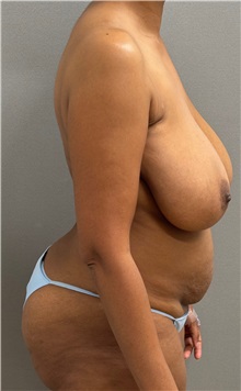 Tummy Tuck Before Photo by Keshav Magge, MD; ,  - Case 50550