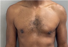 Male Breast Reduction After Photo by Keshav Magge, MD; ,  - Case 50584