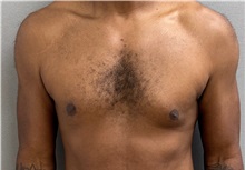 Male Breast Reduction Before Photo by Keshav Magge, MD; ,  - Case 50584
