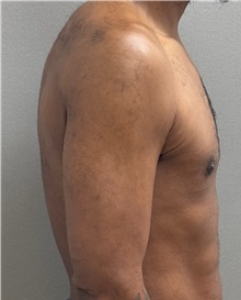 Male Breast Reduction After Photo by Keshav Magge, MD; ,  - Case 50584