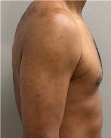 Male Breast Reduction Before Photo by Keshav Magge, MD; ,  - Case 50584