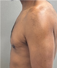 Male Breast Reduction After Photo by Keshav Magge, MD; ,  - Case 50584