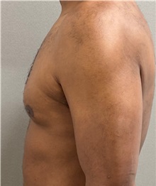 Male Breast Reduction Before Photo by Keshav Magge, MD; ,  - Case 50584