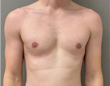 Male Breast Reduction After Photo by Keshav Magge, MD; ,  - Case 50583
