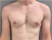 Male Breast Reduction Before Photo by Keshav Magge, MD; ,  - Case 50583