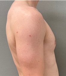 Male Breast Reduction After Photo by Keshav Magge, MD; ,  - Case 50583