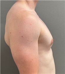 Male Breast Reduction Before Photo by Keshav Magge, MD; ,  - Case 50583