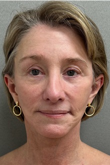 Facelift After Photo by Keshav Magge, MD; ,  - Case 50590