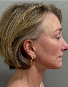 Facelift After Photo by Keshav Magge, MD; ,  - Case 50590