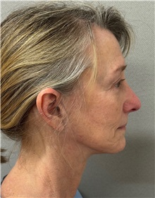 Facelift Before Photo by Keshav Magge, MD; ,  - Case 50590
