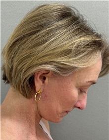 Facelift After Photo by Keshav Magge, MD; ,  - Case 50590