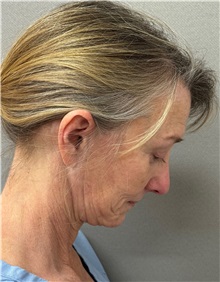 Facelift Before Photo by Keshav Magge, MD; ,  - Case 50590