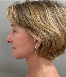 Facelift After Photo by Keshav Magge, MD; ,  - Case 50590