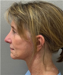 Facelift Before Photo by Keshav Magge, MD; ,  - Case 50590