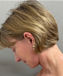 Facelift After Photo by Keshav Magge, MD; ,  - Case 50590