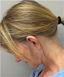 Neck Lift Before Photo by Keshav Magge, MD; ,  - Case 50591