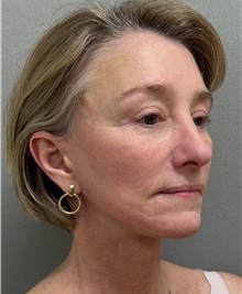 Neck Lift After Photo by Keshav Magge, MD; ,  - Case 50591