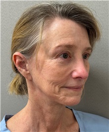 Neck Lift Before Photo by Keshav Magge, MD; ,  - Case 50591