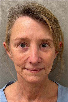 Neck Lift Before Photo by Keshav Magge, MD; ,  - Case 50591