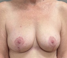 Breast Lift After Photo by Keshav Magge, MD; ,  - Case 50652