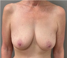 Breast Lift Before Photo by Keshav Magge, MD; ,  - Case 50652