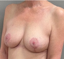 Breast Lift After Photo by Keshav Magge, MD; ,  - Case 50652