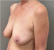 Breast Lift Before Photo by Keshav Magge, MD; ,  - Case 50652