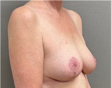 Breast Lift After Photo by Keshav Magge, MD; ,  - Case 50652