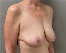 Breast Lift Before Photo by Keshav Magge, MD; ,  - Case 50652