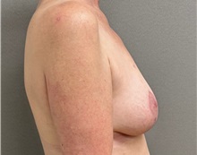 Breast Lift After Photo by Keshav Magge, MD; ,  - Case 50652