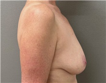 Breast Lift Before Photo by Keshav Magge, MD; ,  - Case 50652