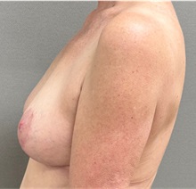 Breast Lift After Photo by Keshav Magge, MD; ,  - Case 50652