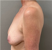 Breast Lift Before Photo by Keshav Magge, MD; ,  - Case 50652