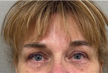 Brow Lift After Photo by Keshav Magge, MD; ,  - Case 50653