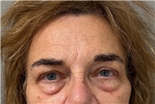Brow Lift Before Photo by Keshav Magge, MD; ,  - Case 50653