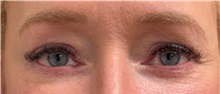 Eyelid Surgery After Photo by Keshav Magge, MD; Bethesda, MD - Case 50812