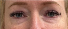 Eyelid Surgery Before Photo by Keshav Magge, MD; Bethesda, MD - Case 50812