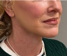Facelift After Photo by Keshav Magge, MD; Bethesda, MD - Case 50811