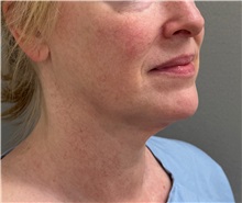 Facelift Before Photo by Keshav Magge, MD; Bethesda, MD - Case 50811