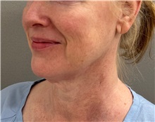 Facelift Before Photo by Keshav Magge, MD; Bethesda, MD - Case 50811