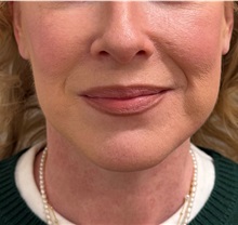 Facelift After Photo by Keshav Magge, MD; Bethesda, MD - Case 50811