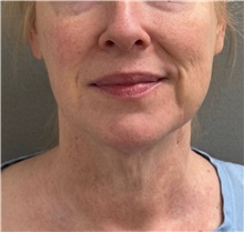 Facelift Before Photo by Keshav Magge, MD; Bethesda, MD - Case 50811