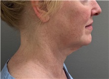 Facelift Before Photo by Keshav Magge, MD; Bethesda, MD - Case 50811