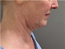 Facelift Before Photo by Keshav Magge, MD; Bethesda, MD - Case 50811