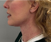 Facelift After Photo by Keshav Magge, MD; Bethesda, MD - Case 50811
