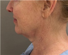 Facelift Before Photo by Keshav Magge, MD; Bethesda, MD - Case 50811